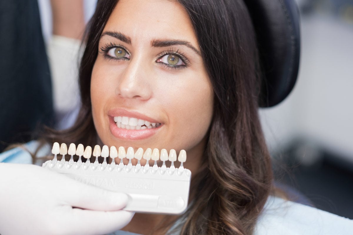 How Long Do Veneers Last on Average?