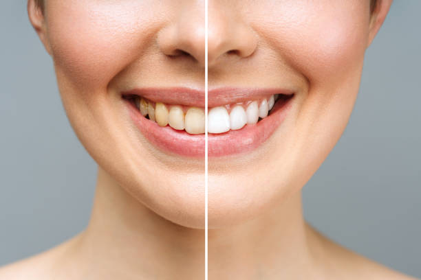 Read more about the article Achieve a Brighter Smile with Professional Teeth Whitening in Main Line, PA