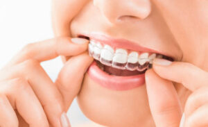 Invisalign in Bryn Mawr: Why Clear Aligners Are the Smart, Subtle Way to Straighten Your Smile