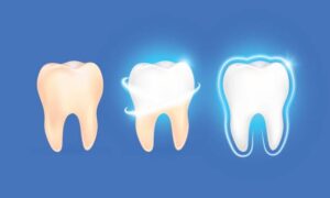 What to Expect from Dillon Family Dentistry’s Teeth Whitening Treatment