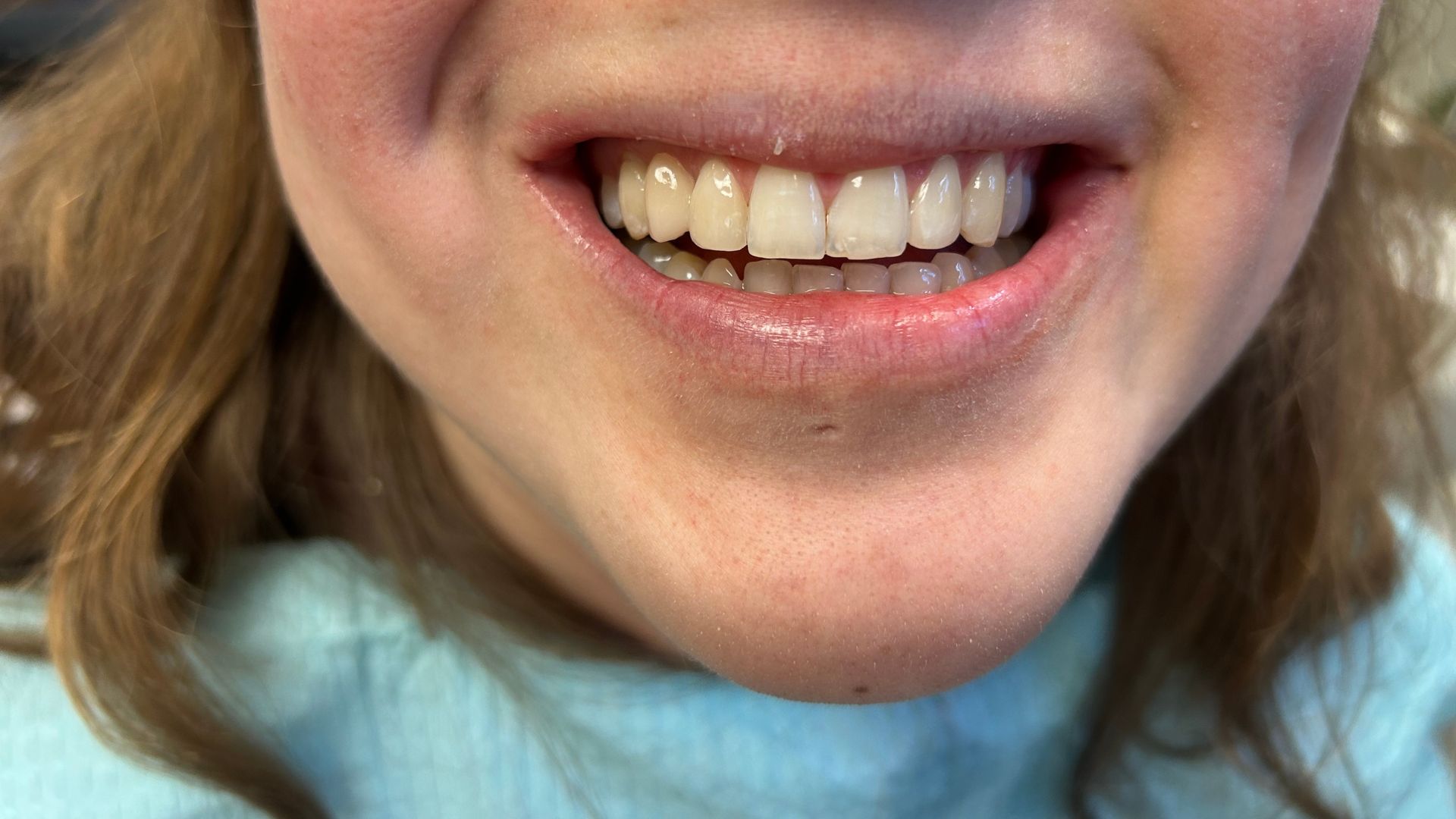 Read more about the article Why Are My Teeth Yellowing Even After Brushing?