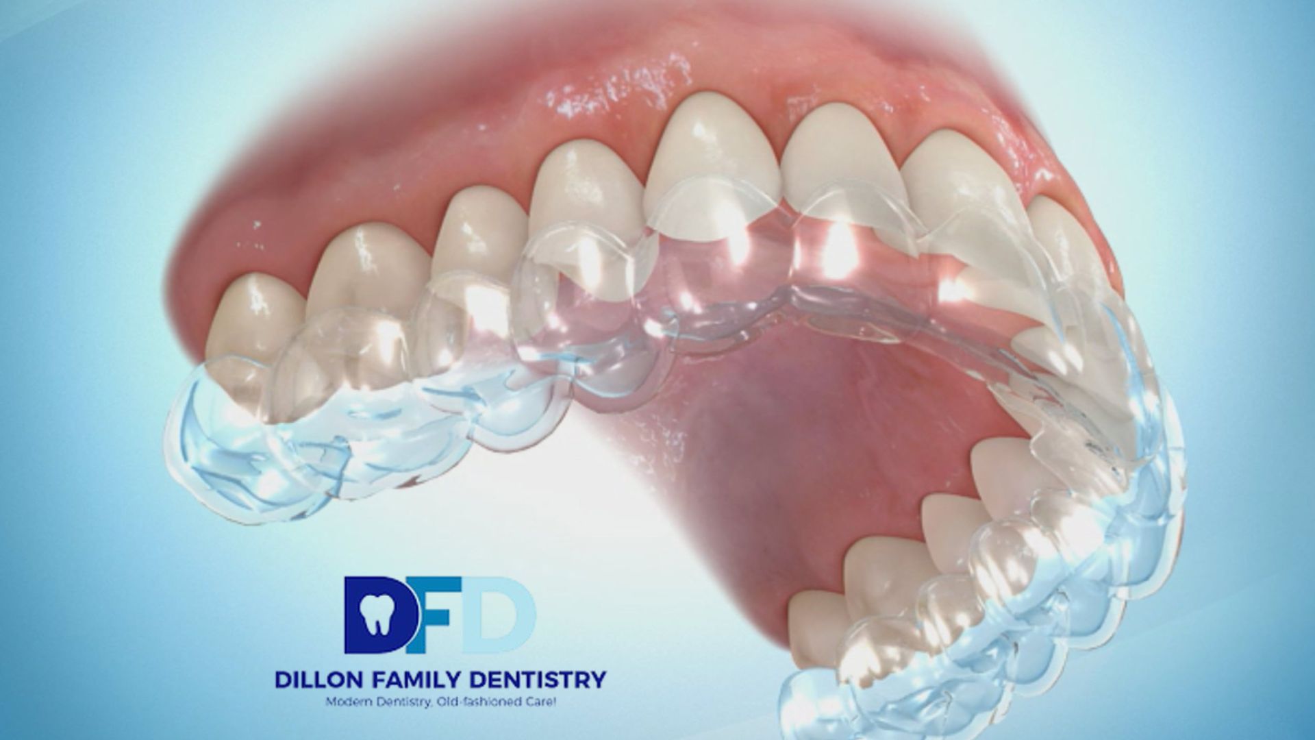 Read more about the article Are Invisalign Retainers Permanent? What Dentists Recommend