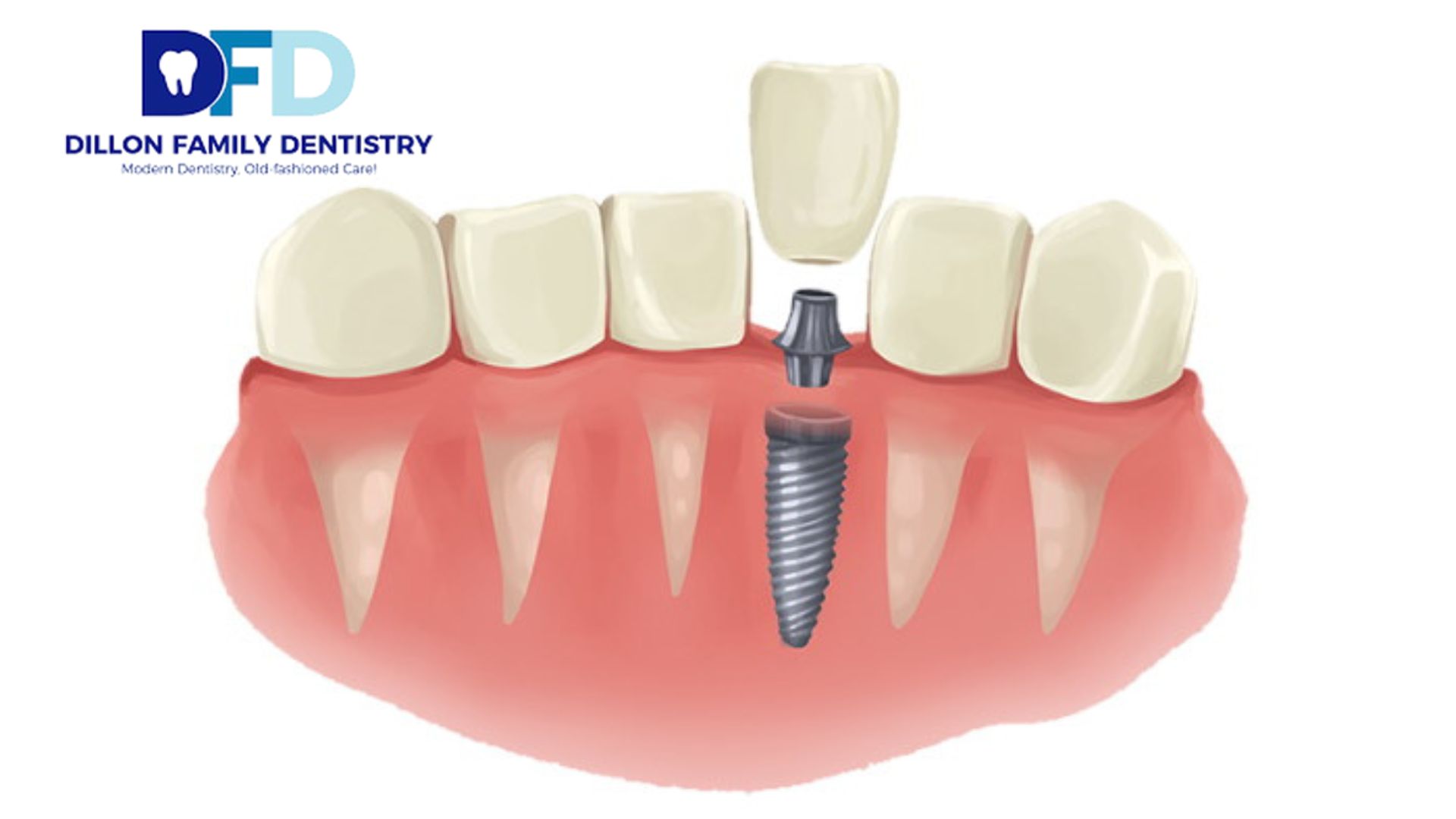 Read more about the article Can You Get Same-Day Dental Implants in the Main Line?