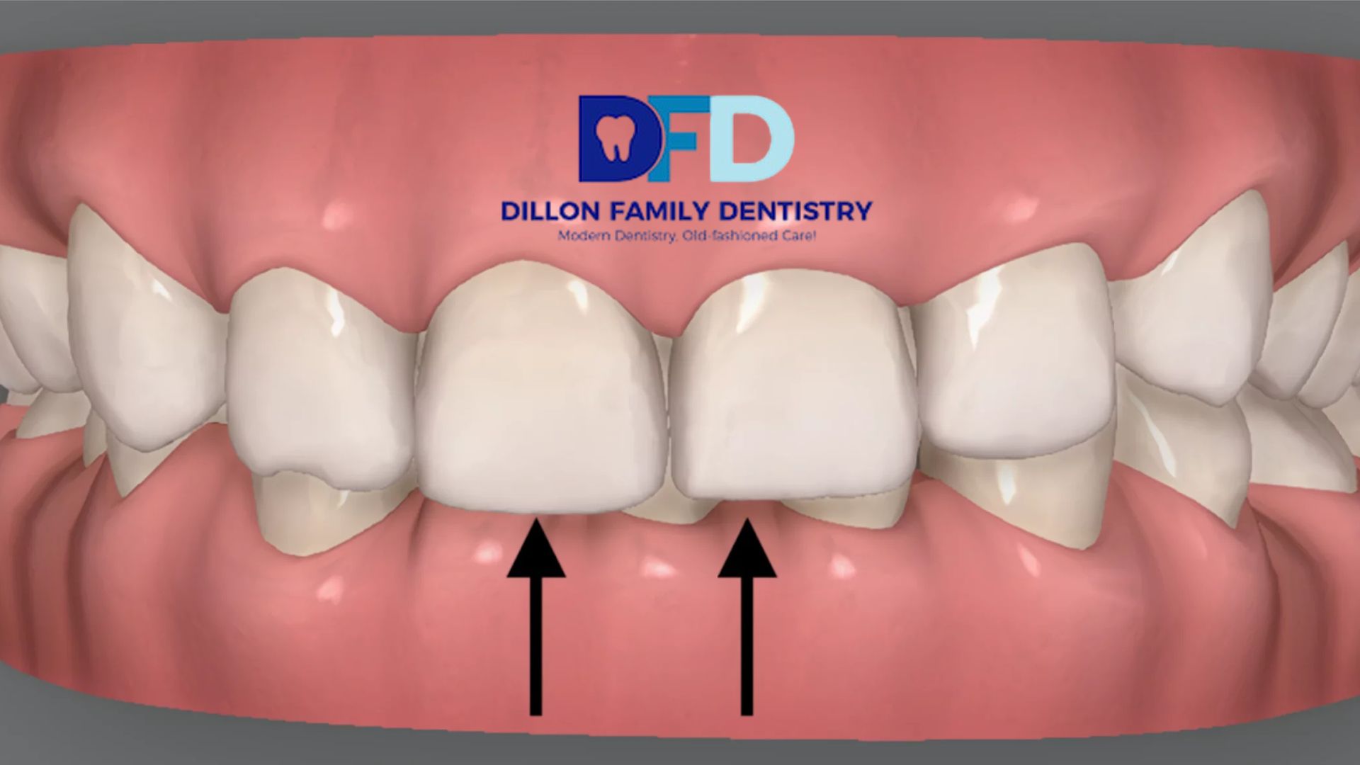 Read more about the article Can Invisalign Fix Bite Problems or Only Crooked Teeth?