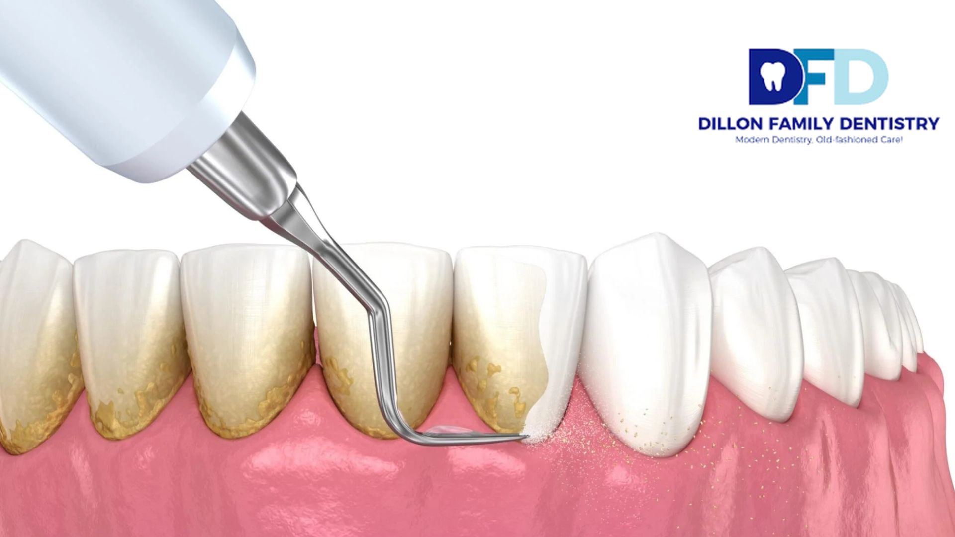 Read more about the article How Teeth Cleaning in Bryn Mawr Helps Prevent Gum Disease