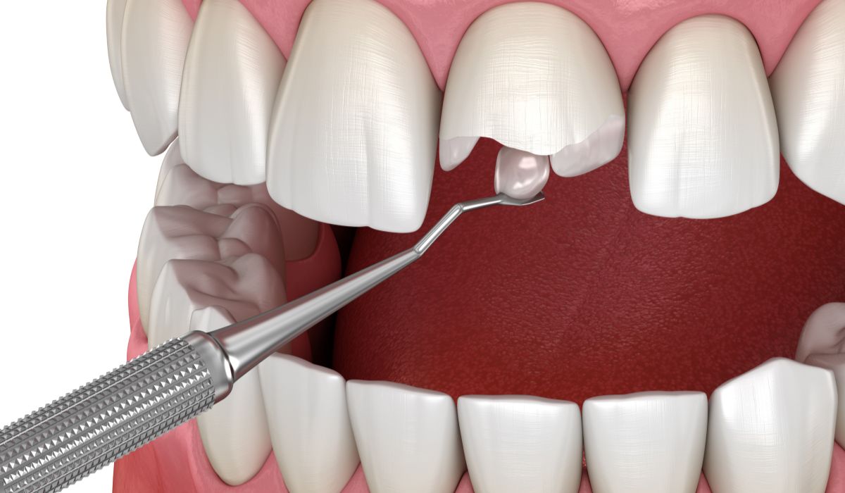 Read more about the article Main Line Best Dentist for Broken Tooth Treatment: What to Do First
