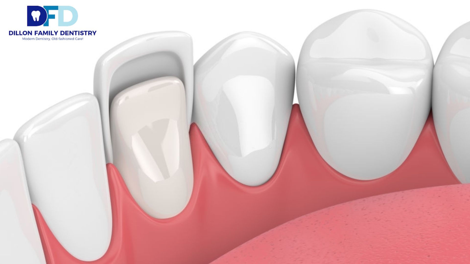 Read more about the article What Dental Issues Can Veneers Fix?