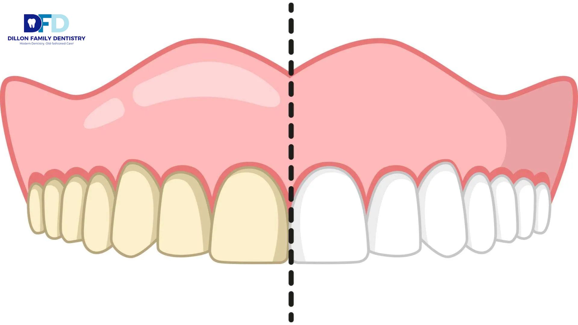 Read more about the article Why Did My Teeth Become Sensitive After Whitening?