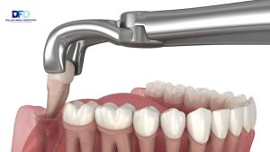 Tooth Extraction