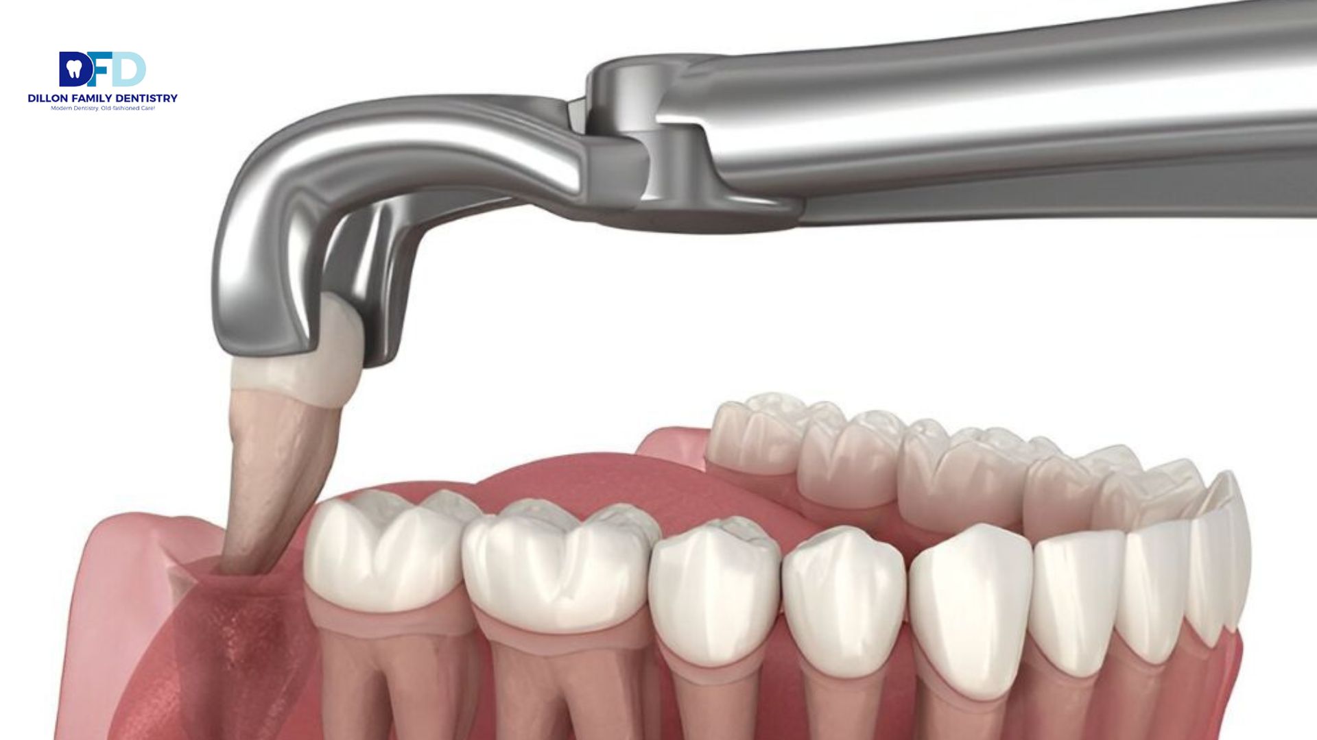 Read more about the article Need a Tooth Extraction in the Main Line?
