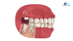 Tooth Pain