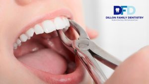 Read more about the article How Painful Is a Tooth Extraction? 