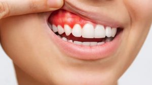 Bleeding Gums