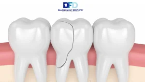 Cracked Tooth