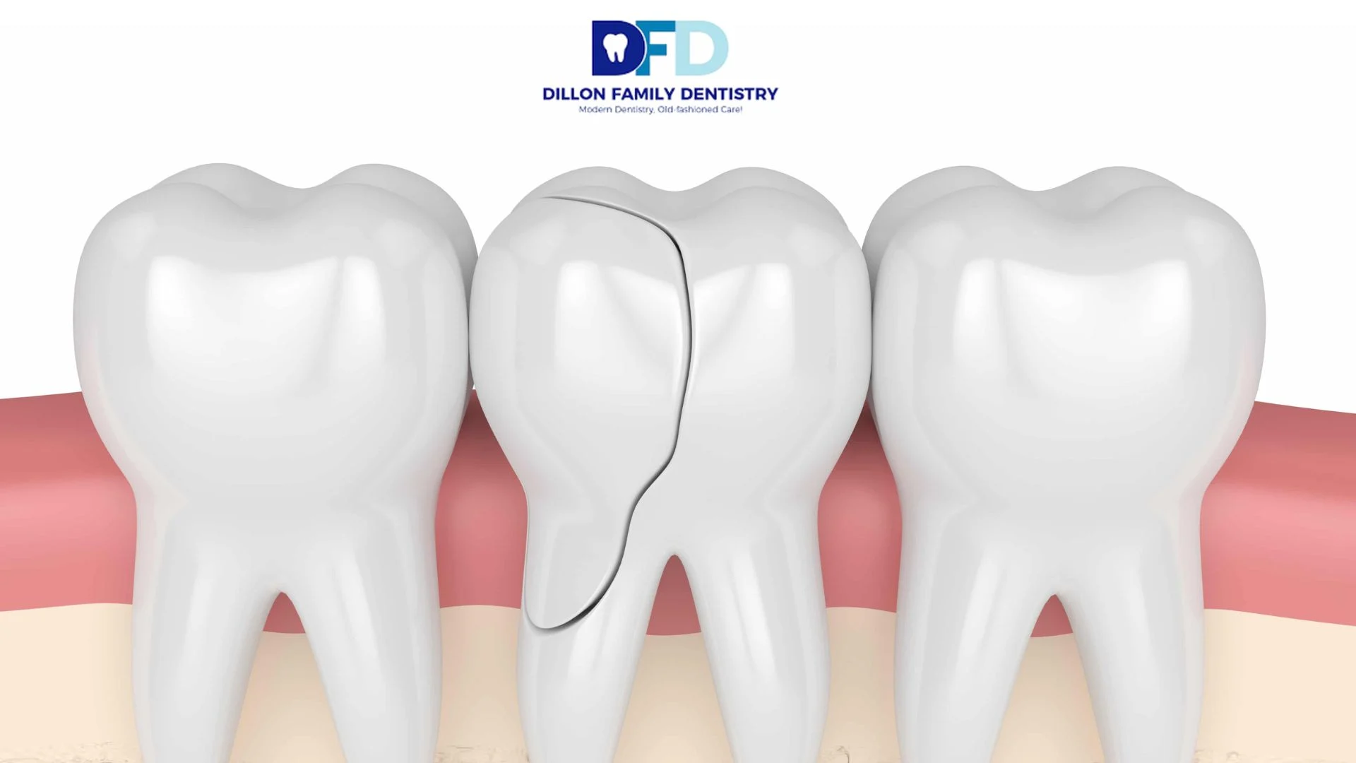 Read more about the article Cracked Tooth Emergency: What To Do Before You Reach a Dentist