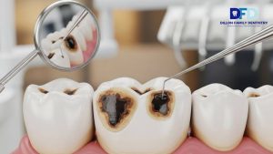 Read more about the article Black Spot on Tooth: Cavity, Stain, or Something Serious? 
