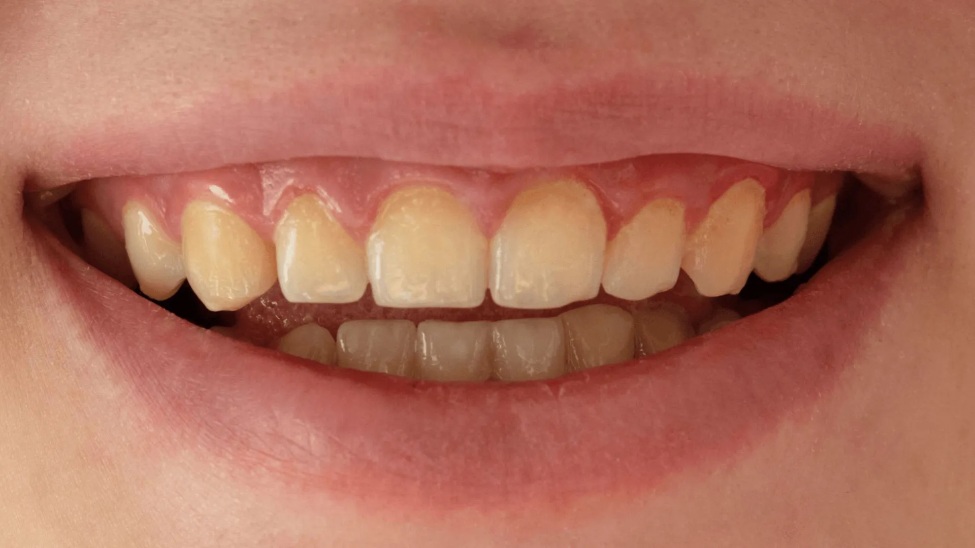 You are currently viewing Yellow Teeth Despite Brushing Daily? The Real Reasons Behind Tooth Stains