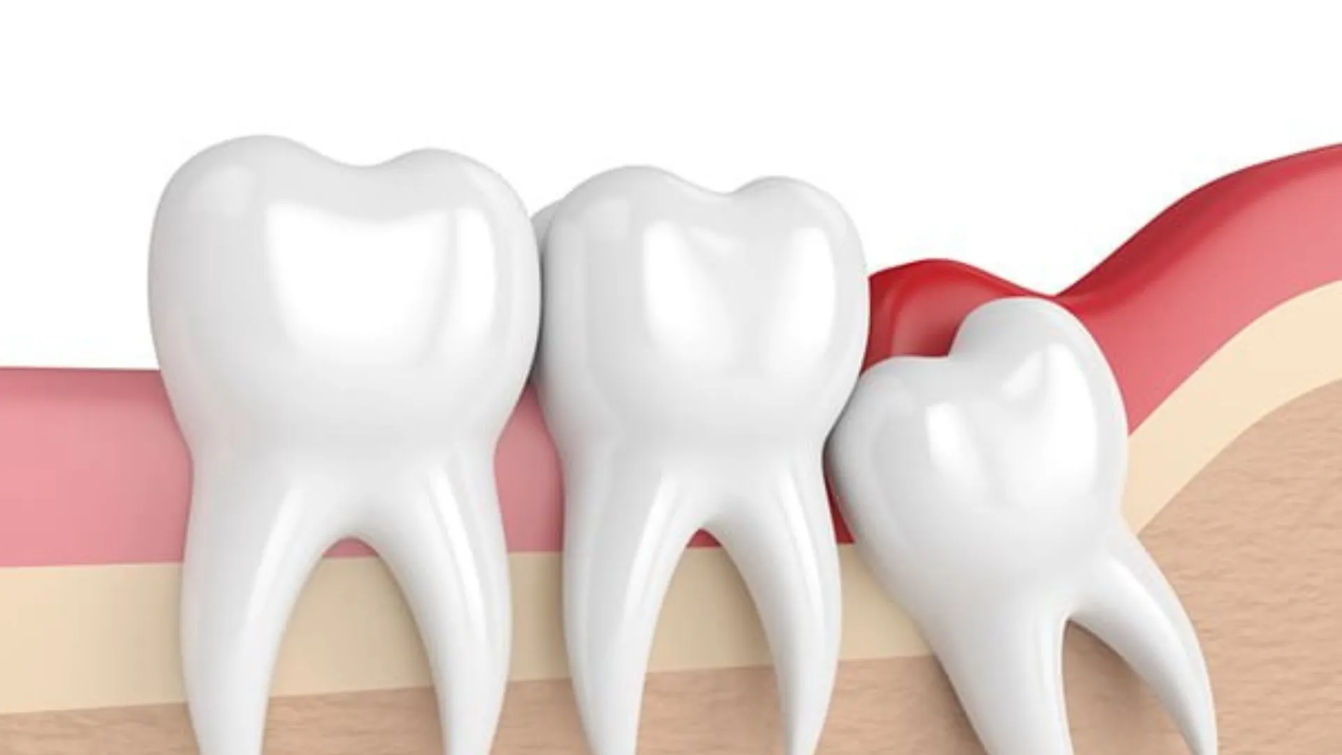 Read more about the article Upper Wisdom Tooth Removal in Bryn Mawr: What to Expect Before, During & After
